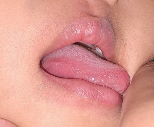 Ruam sekitar bibir ketika sakit