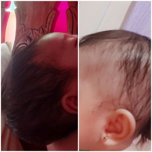 Hair loss of baby