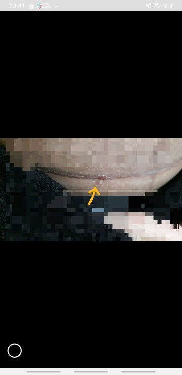 แผลผ่าคลอด