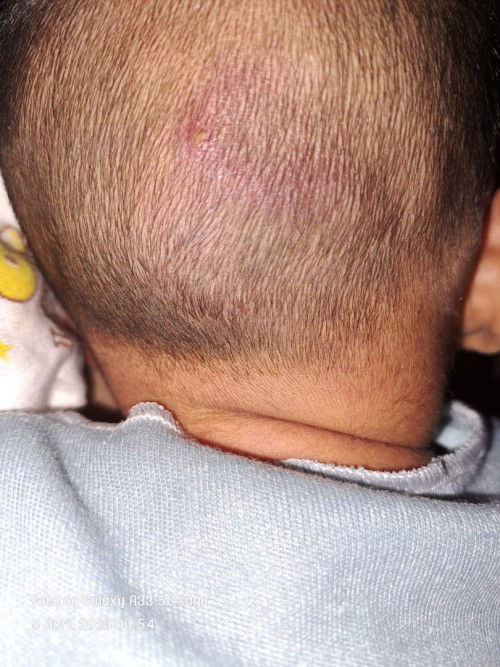 BENJOLAN DIKEPALA BAYI UMUR 2 MINGGU