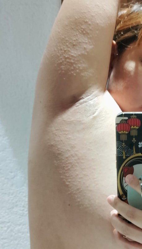 Rashes Kati-Kati Habang Buntis