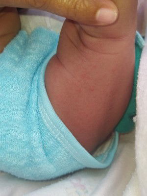 Bintik merah di pantat bayi