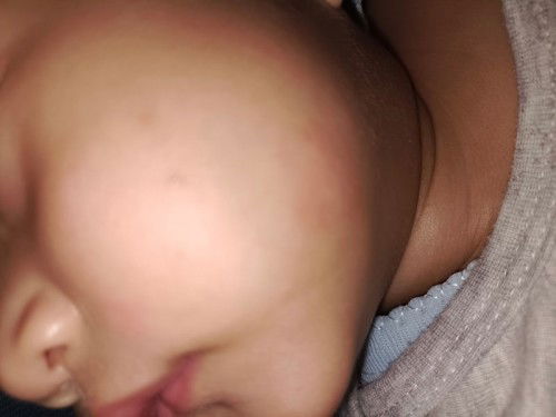 Merah Kasap di kulit