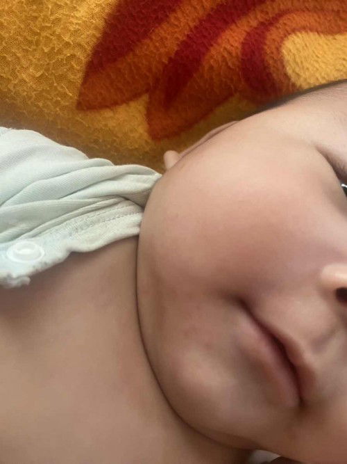 Bé nhà em ngủ dậy đã bị nổi những mẩn đỏ này nhưng ko ngứa ko có dấu hiệu sốt hay mệt mỏi ho