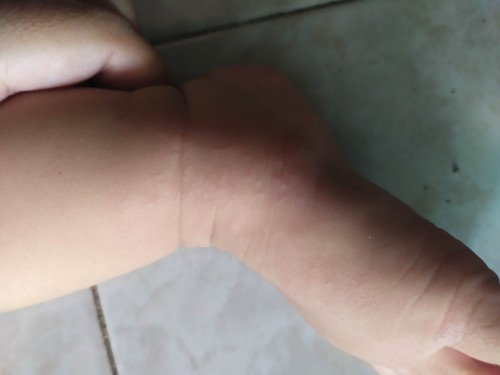 bintik pada anak