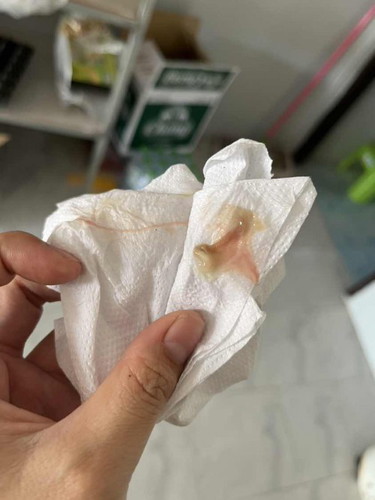 แบบนี้ควรไป รพ เลยมั้ยคะ