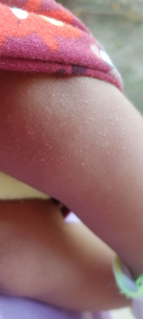 Bruntusan pada pagi usia 1 bulan setengah