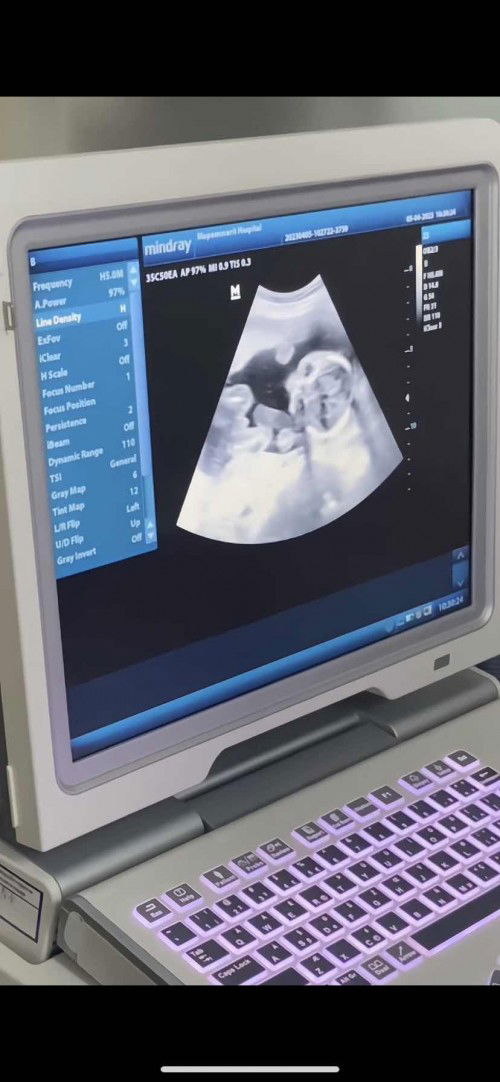 อัตราซาวด์ ท้อง