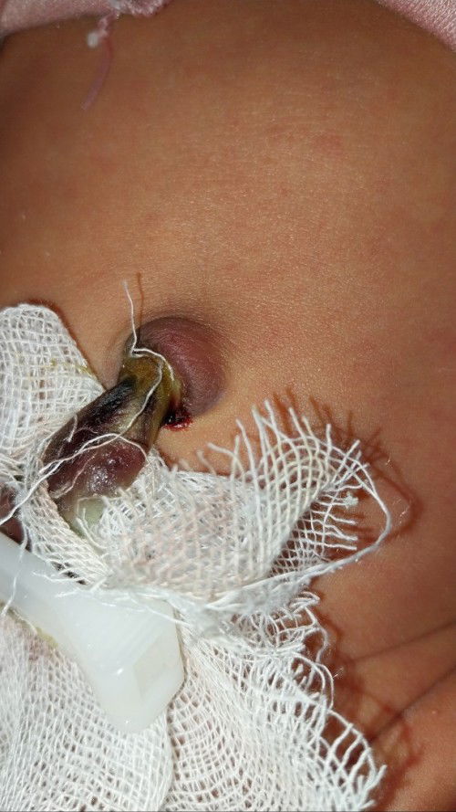 Tali pusar agak berdarah