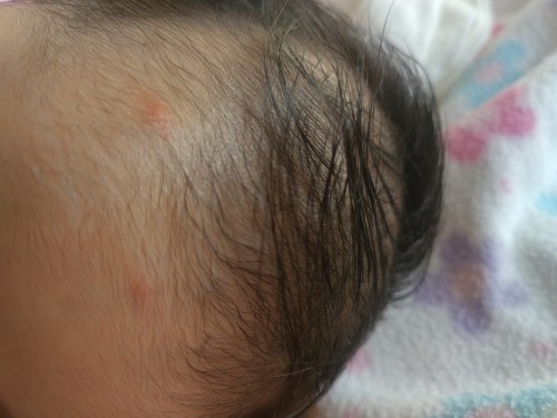 Pimple like sa forehead ni baby