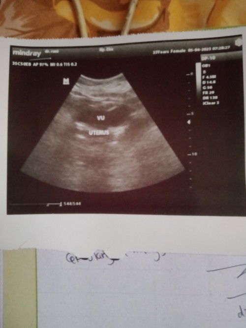 USG 7 minggu 6hari tapi pendarahan gumpalan dan keluar yang putih