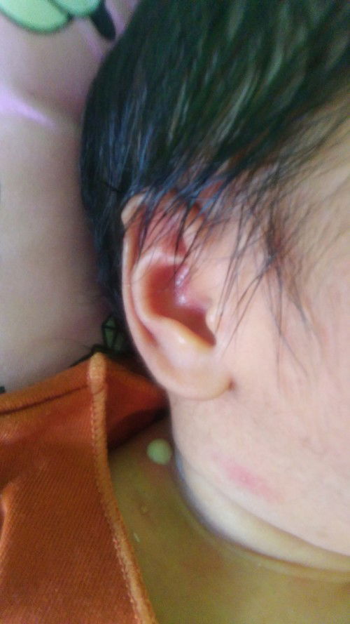 Bengkak leher bernanah