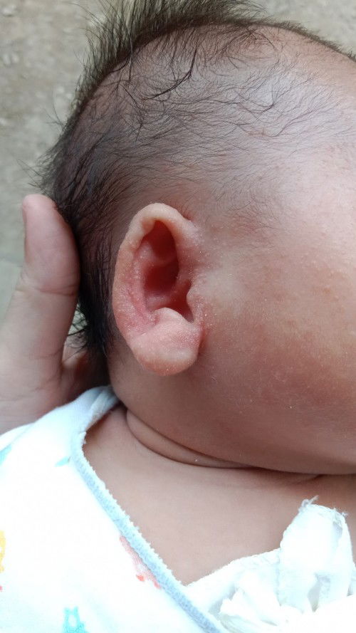 Cara menghilangkan bruntus pada bayi