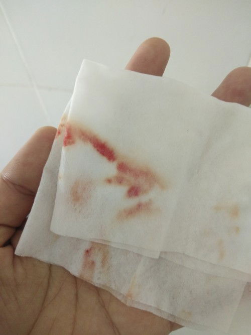 Bleeding po ba ?