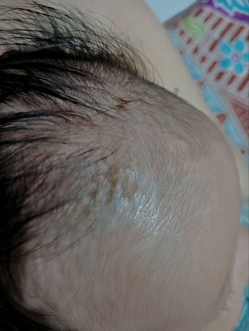 Kulit kepala muncul sesuatu