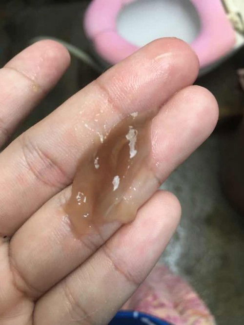 35+2 วีค มูกเลือดไหม ไม่แน่ใจ