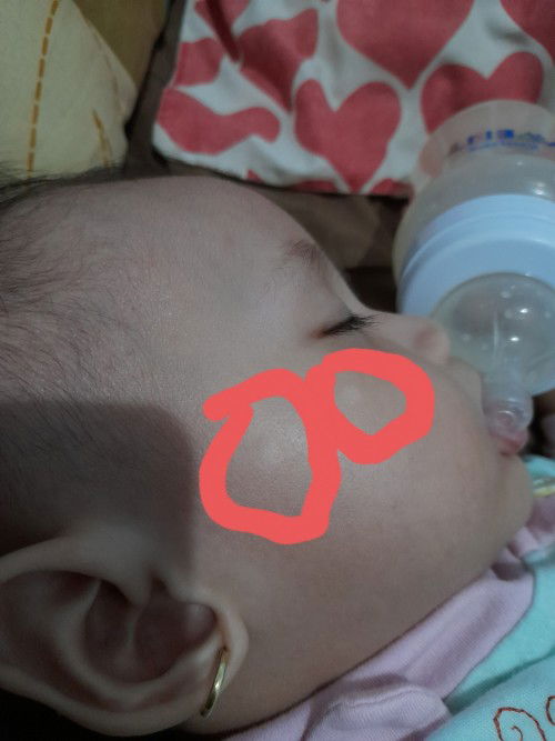 Bercak putih di wajah bayi