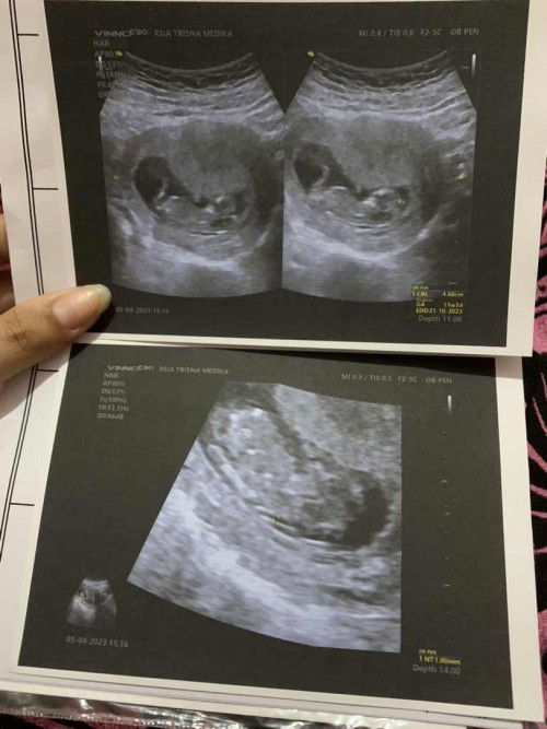 tentang down syndrom