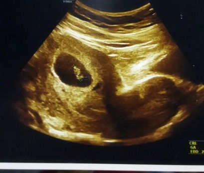 Perdarahan di sekitar kantung janin