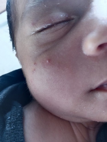 Newborn Acne