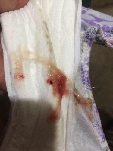 mucus plug?