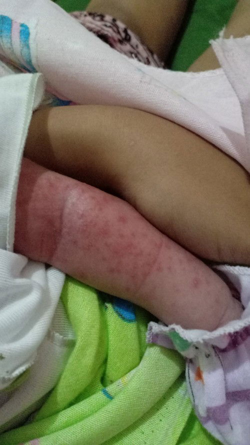 Bund mau tanya dong ini obatinnya pake apa ya kulit nya tiba*merah dan bintik*