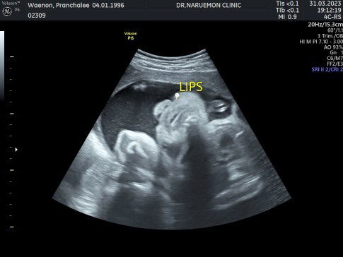 รบกวนแม่ๆ ช่วยดูภาพอัลตราซาวน์นี้หน่อยค่ะ อายุครรภ์ 32 W ตรงปากน้องค่ะ มีอาการปากแหว่งมั้ยคะ