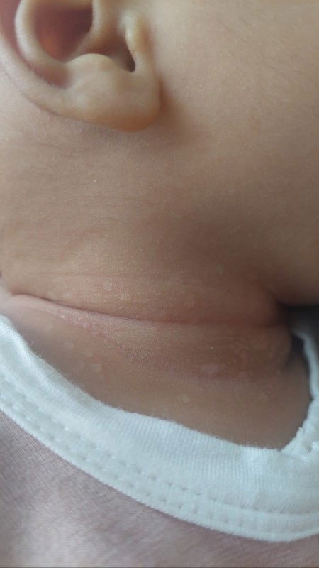 Problem kulit leher bayi 2 bulan
