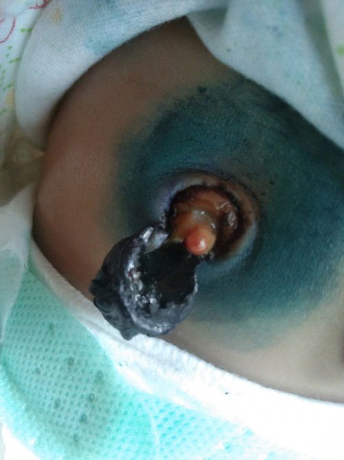 สะดือลูกน้อย