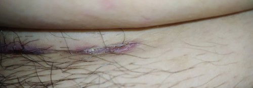 ผ่าคลอดมาจะสามเดือนแล้ว