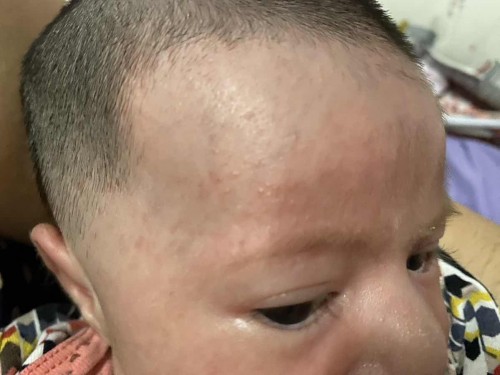 ผื่นเม็ดร้อนใช่ไหมคะ