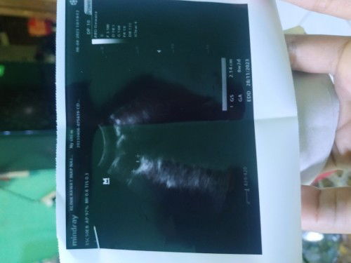 Hasil usg klinik sama pkm beda