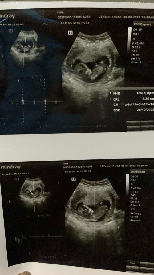 Usg 11w6d tapi dokternya ga komunikatif