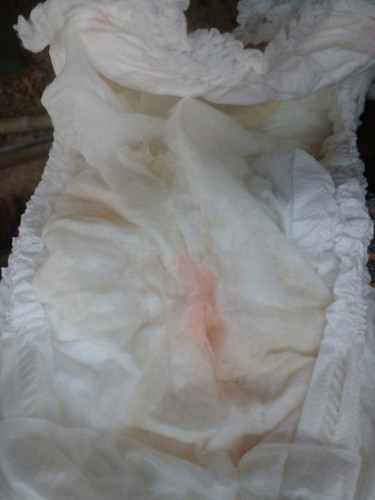 แม่ๆสาเหตุนี้เกิดจากอะไรคะ พอดีน้องมีฉี่สีแดงๆติดแพมเพิสออกมา หลังจากได้รับการฉีดวัคซีน2เดือนมาคะ