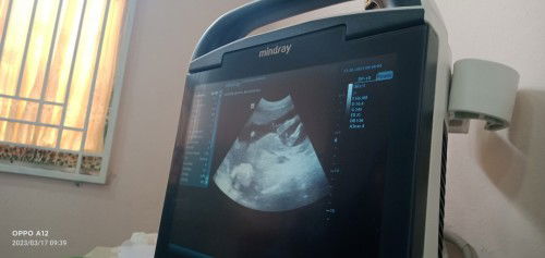 Mau tnya nie bunda² aku lg hamil anak kdua kemrin USG 18wek tp aku gk ngerti Krn anak 1 gk prnh usg