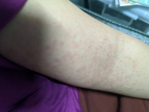 Ano po gamot niyo sa Postpartum hives? 😭🥺