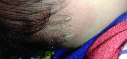 Merah seperti ada nanah