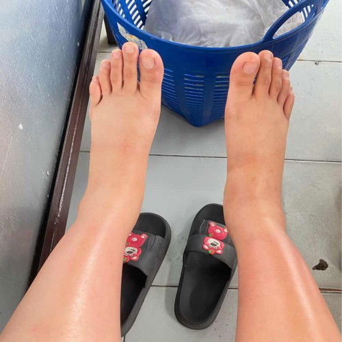 8 เดือน บวมแบบนี้ปกติไหม