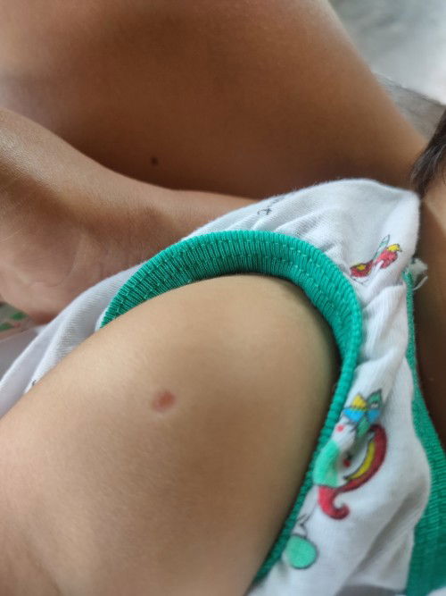 Dalawang turok ng BCG