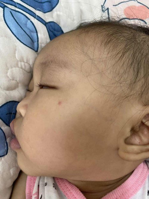 Gigit nyamuk atau bukan