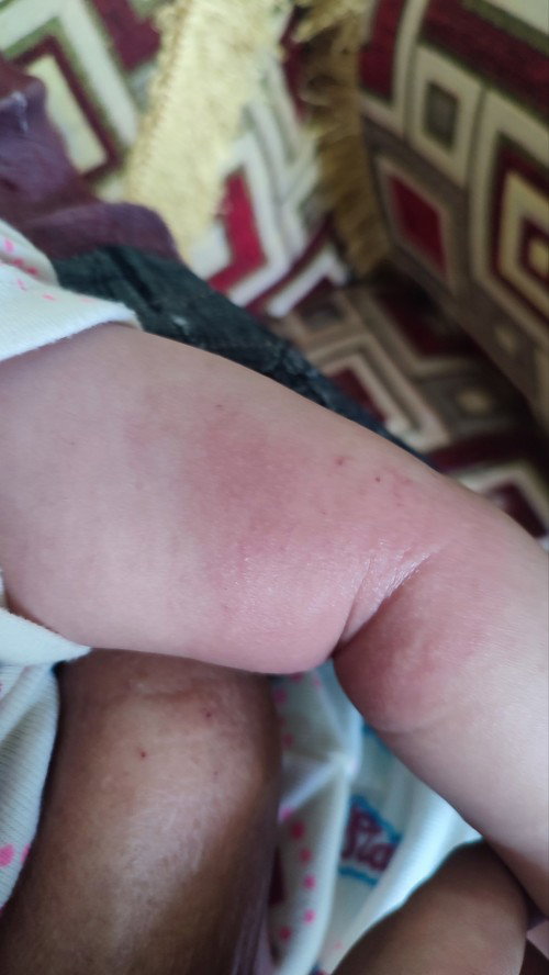 Tangan di pergelangan kasar bayi umur 6 bulan