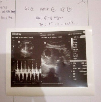 Ini hsil USG saya Bun kmrin sore..Kta y usia kandungan baru 8-9 Minggu sedangkan prediksi bidan udh