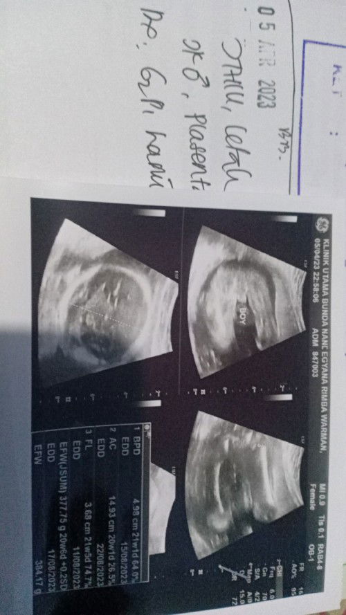 Hasil usg jenis kelamin