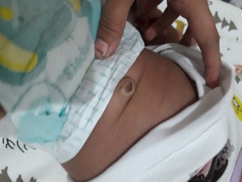 Umbilical hernia @2mos baby girl