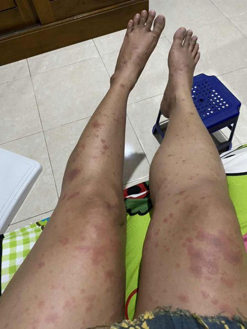 Gatal gatal trimester 3