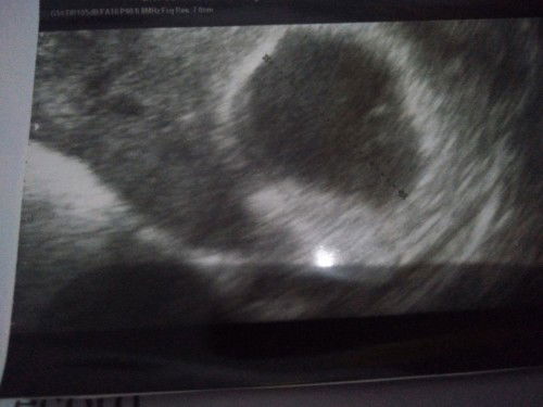 Hamil 6w, belum terlihat janin