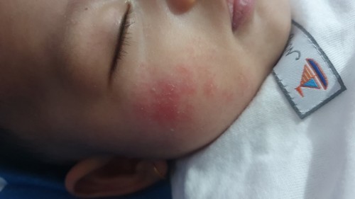 Ruam pipi
Apa benar cara cepat ngilangin pakai air liur mamah nya pas bener" baru bangun tidur?