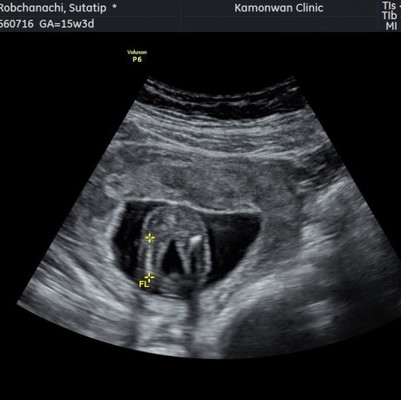 15w4d
น้องนอนคว่ำ แต่ป้าหมอให้ดูทางก้นคาดว่าจะเป็นผู้หญิง แม่ๆบ้านอื่นน้องให้เห็นเพศยังคะ