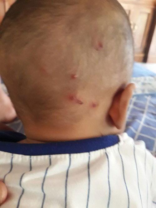 bintik merah bayi 8 bulan