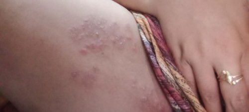 Ada yg tau gak bun obat yg aman buat bumil buat ngobatin ini di bagian paha dalam gatel banget 😌